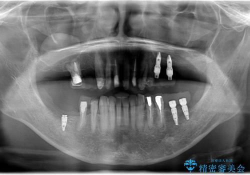 古い金属の治療で奥歯がなくなった方のインプラント、セラミック治療の治療中