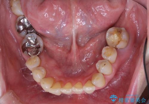 歯ぎしり・食いしばりから歯を守る高性能ナイトガードの治療前
