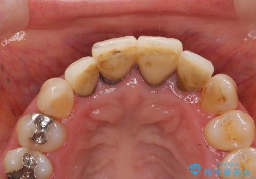 [emax セラミッククラウン] リーズナブルな前歯部審美セラミック治療の治療前