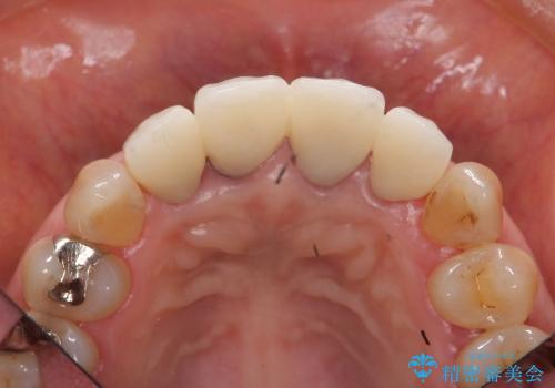 [emax セラミッククラウン] リーズナブルな前歯部審美セラミック治療の治療後