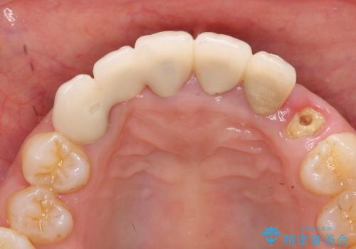 歯ぐきの腫脹も改善、セラミッククラウンのやりかえ治療の治療前