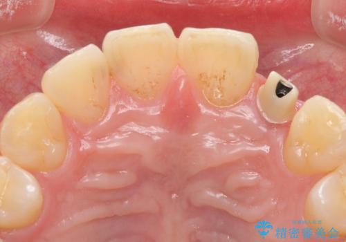 [骨造成を伴う前歯部審美インプラント治療②] ジルコニアカスタムアバットメント・クラウンの作製の治療中