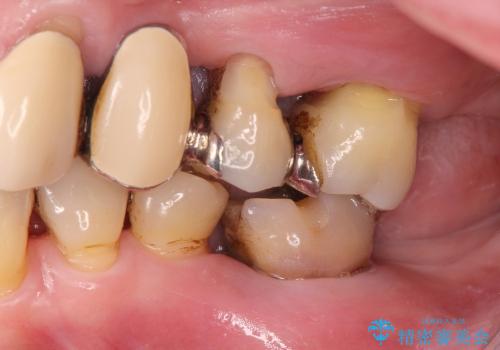 噛み合わせ、前歯を守る 奥歯インプラントの治療前