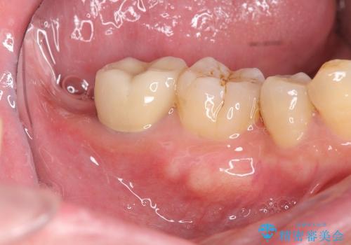 親知らず放置が原因の深い虫歯の治療後