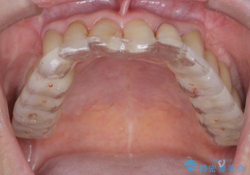 歯ぎしり・食いしばりから歯を守る高性能ナイトガードの症例 治療後