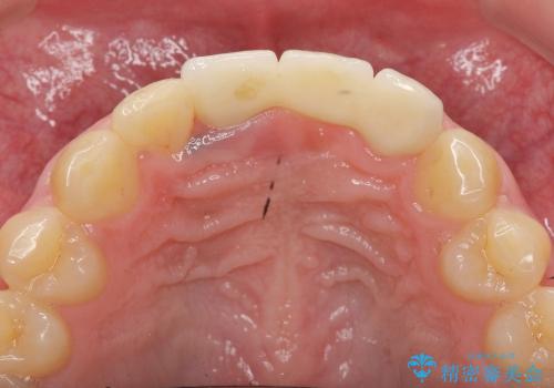 前歯のぐらつき　前歯部審美ブリッジ治療の治療後