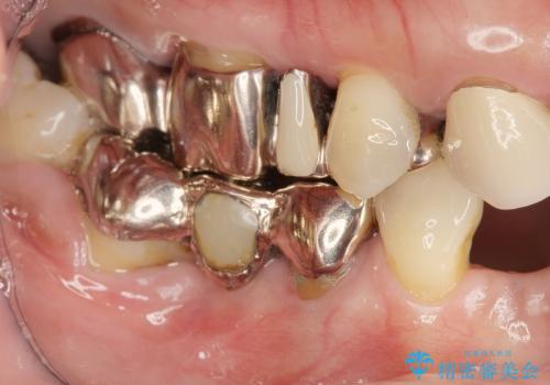 [歯周病全顎治療] インプラントによる咬合機能回復と前歯審美改善の治療前