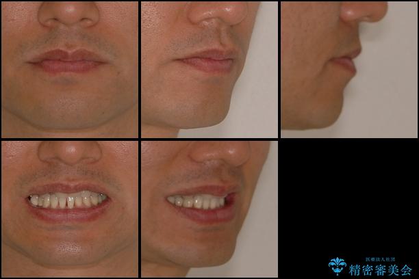 前歯の歯並びの改善　クリアブラケットによる矯正治療　の治療前（顔貌）