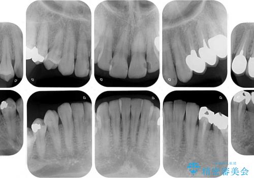 全顎虫歯治療　セラミックで白い歯にの治療前