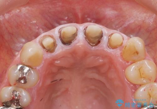 [emax セラミッククラウン] リーズナブルな前歯部審美セラミック治療の治療中