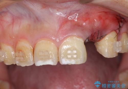 [骨造成を伴う前歯部審美インプラント治療①] インプラント埋入・骨造成・2次手術の治療中