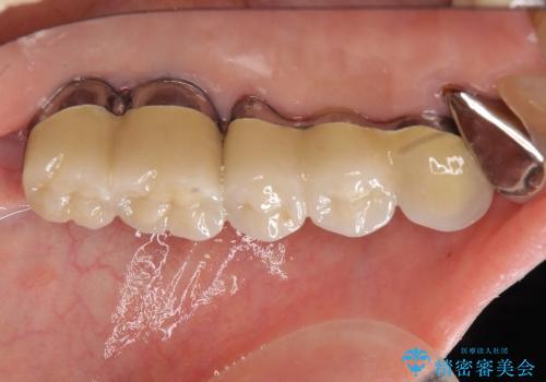 噛み合わせ、前歯を守る 奥歯インプラントの治療後