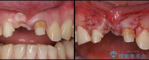 前歯が折れた　歯肉移植を用いた前歯のブリッジの治療中