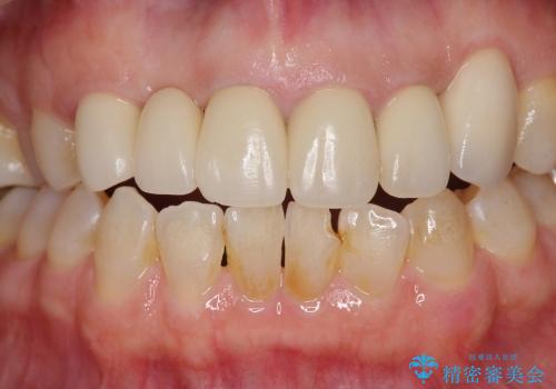 歯ぐきの腫脹も改善、セラミッククラウンのやりかえ治療の治療後