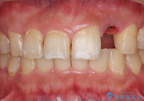[骨造成を伴う前歯部審美インプラント治療②] ジルコニアカスタムアバットメント・クラウンの作製の治療前