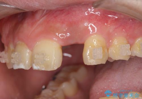 [骨造成を伴う前歯部審美インプラント治療①] インプラント埋入・骨造成・2次手術の症例 治療後