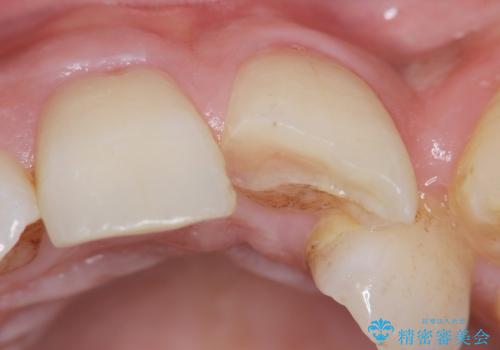 [外傷歯の治療] ころんでぶつけて折れた前歯の審美回復の治療前
