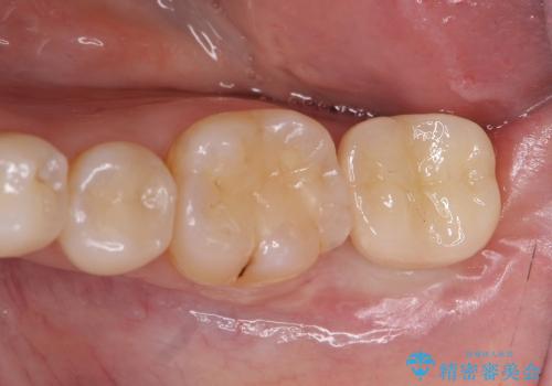 [straumann implant] 薄くなった歯牙の破折　インプラントによる咬合回復の治療後
