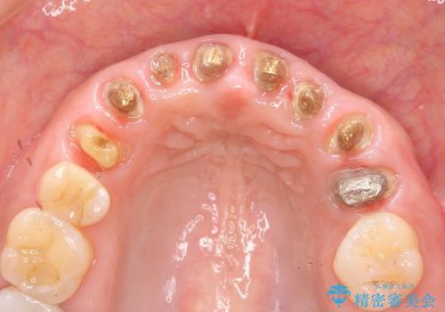 [歯ぐきからの出血]　歯肉の状態を改善する前歯オールセラミック治療①の治療中