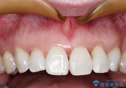 30代女性　前歯の限局的な歯周病を治療する①～再生治療の症例 治療前