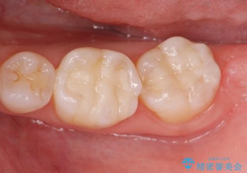 [奥歯を白く]　コンポジットレジン・銀歯のやりかえの症例 治療後