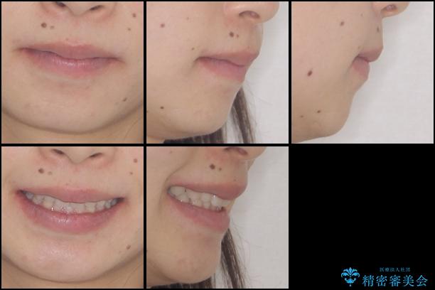 インビザラインによる出っ歯とすきっ歯の改善の治療後（顔貌）