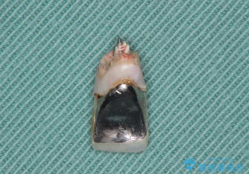 [歯槽堤保存術を併用したブリッジの作製]　可能な限り歯ぐきの厚みを保存し審美的にの治療前