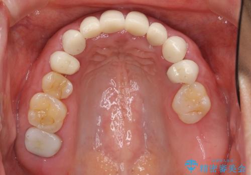 [歯ぐきからの出血]　歯肉の状態を改善する前歯オールセラミック治療①の治療前