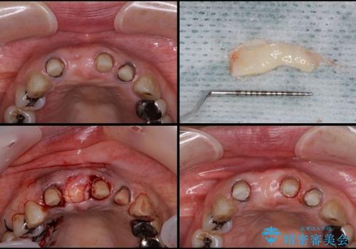 前歯が折れた　歯肉移植を用いた前歯のオールセラミックブリッジの治療中