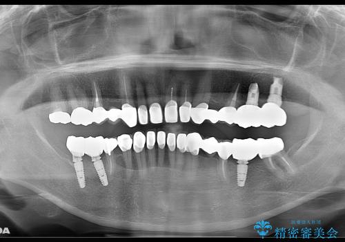 噛めないところをインプラントに、残せない歯を残す治療の治療後