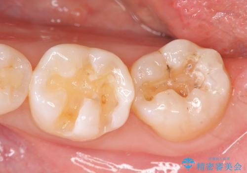 [奥歯を白く]　コンポジットレジン・銀歯のやりかえの治療中
