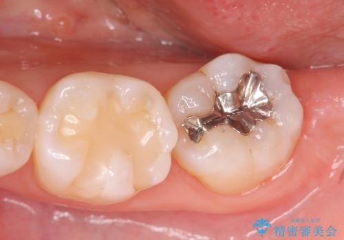 [奥歯を白く]　コンポジットレジン・銀歯のやりかえの症例 治療前