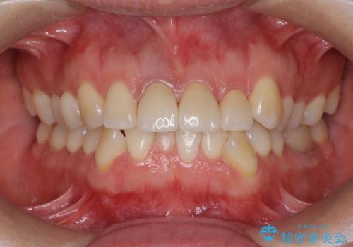 [神経の死んだ歯の変色] 前歯審美セラミック治療の治療後