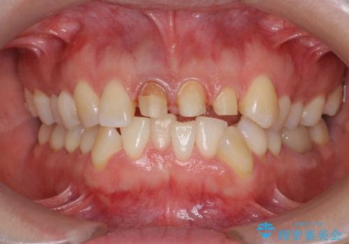 [神経の死んだ歯の変色] 前歯審美セラミック治療の治療中