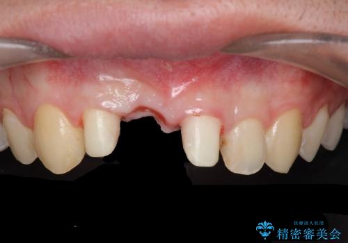[歯槽堤保存術を併用したブリッジの作製]　可能な限り歯ぐきの厚みを保存し審美的にの症例 治療後