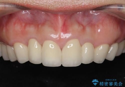 [歯ぐきからの出血]　歯肉の状態を改善する前歯オールセラミック治療②の症例 治療後