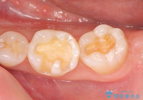 [奥歯を白く]　コンポジットレジン・銀歯のやりかえの治療中