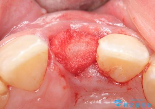 [歯槽堤保存術を併用したブリッジの作製]　可能な限り歯ぐきの厚みを保存し審美的にの治療中