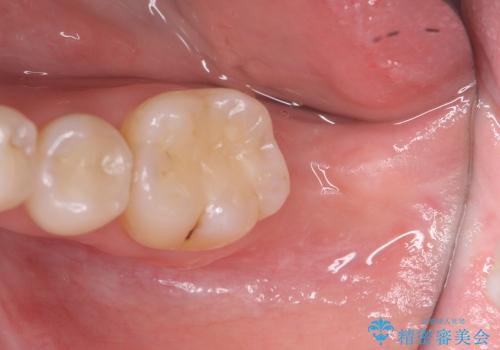 [straumann implant] 薄くなった歯牙の破折　インプラントによる咬合回復の治療中