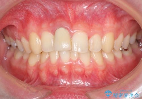 [歯の破折] 歯槽堤保存術を応用した前歯部セラミック治療の治療前