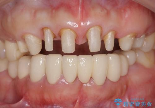 [歯ぐきからの出血]　歯肉の状態を改善する前歯オールセラミック治療②の治療中