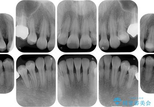 インプラント治療と矯正治療による総合歯科診療の治療後