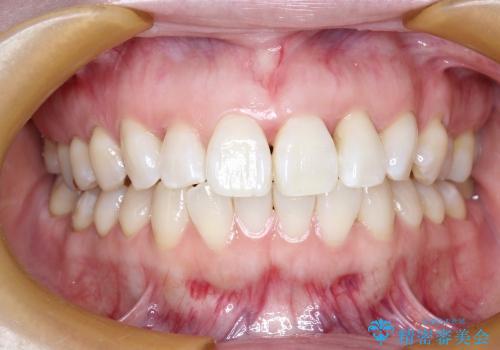 30代女性　前歯の限局的な歯周病を治療する①～再生治療の治療前
