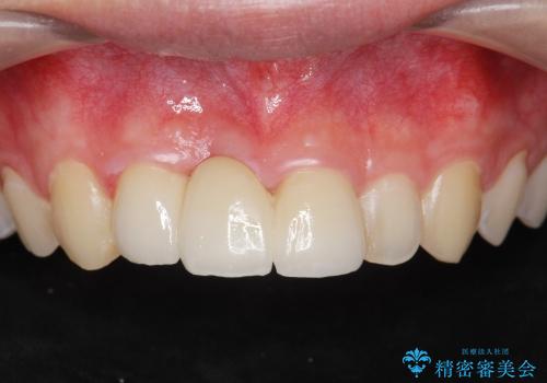 [歯の破折] 歯槽堤保存術を応用した前歯部セラミック治療の症例 治療後