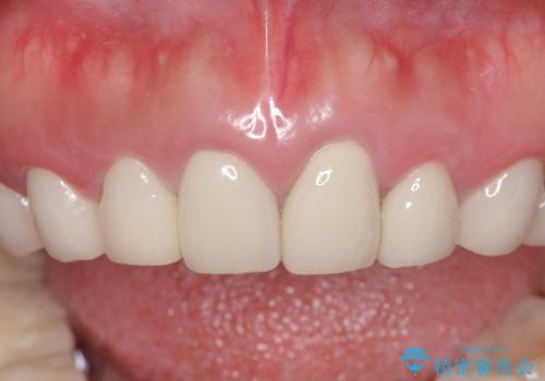 [歯ぐきからの出血]　歯肉の状態を改善する前歯オールセラミック治療①の症例 治療前