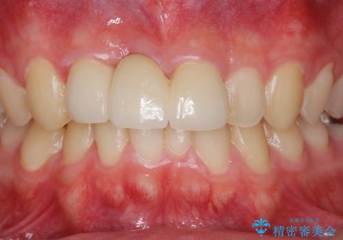 [歯の破折] 歯槽堤保存術を応用した前歯部セラミック治療の治療後