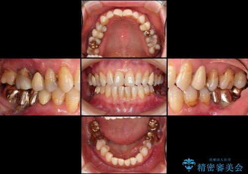咬み合わせが悪くて奥歯が抜歯に　矯正治療と奥歯のセラミックブリッジの治療前