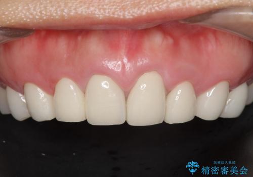 [歯ぐきからの出血]　歯肉の状態を改善する前歯オールセラミック治療②の症例 治療前