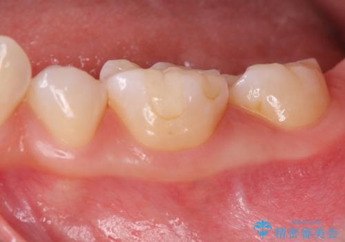 [奥歯を白く]　コンポジットレジン・銀歯のやりかえの治療後