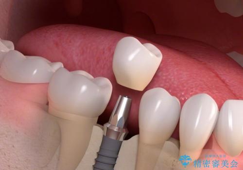 [straumann implant] 薄くなった歯牙の破折　インプラントによる咬合回復